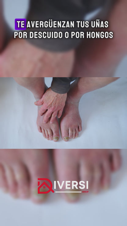 Laser de uñas para los hongos - Tratamiento anti-hongos sin químicos, sin dolor y con resultados reales